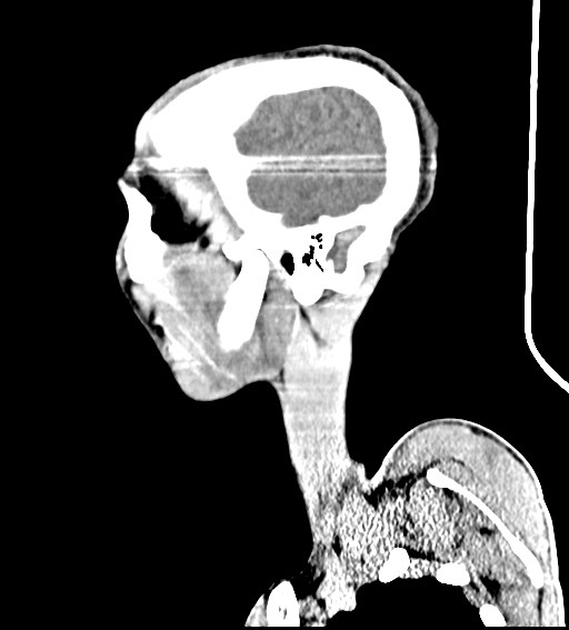 Arrow injury to the brain (Radiopaedia 72101-82607 H 16).jpg