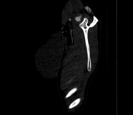 Arteria lusoria (Radiopaedia 88528-105192 C 14).jpg
