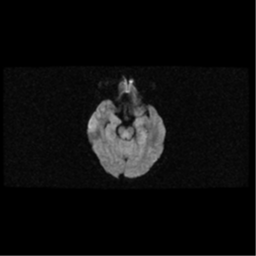 File:Arteriovenous malformation (cerebral) (Radiopaedia 40070-42580 Axial DWI 9).png
