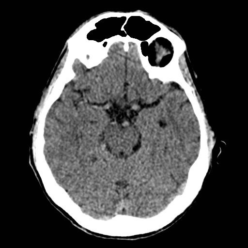 File:Artery of Percheron infarct (Radiopaedia 48088-52893 Axial non-contrast 15).jpg