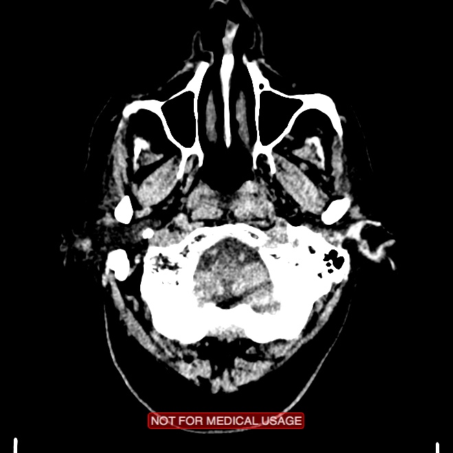 Artery of Percheron infarction (Radiopaedia 28679-28967 Axial non-contrast 10).jpg