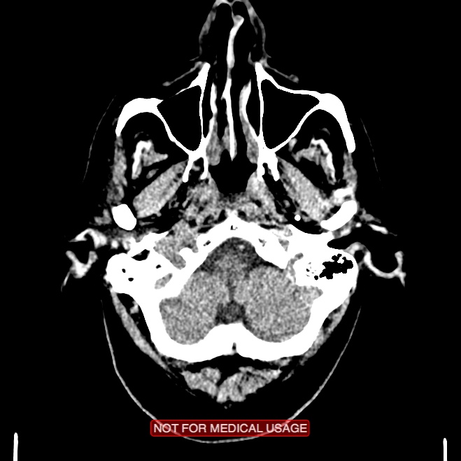 Artery of Percheron infarction (Radiopaedia 28679-28967 Axial non-contrast 14).jpg