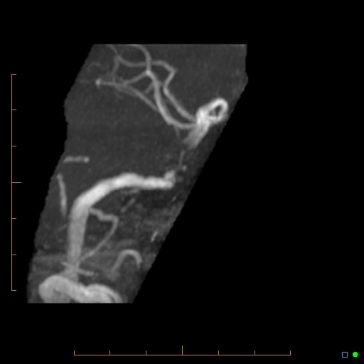 File:Artifactual basilar artery stenosis due to metallic stent (Radiopaedia 31206-31922 3D MIP 11).jpg