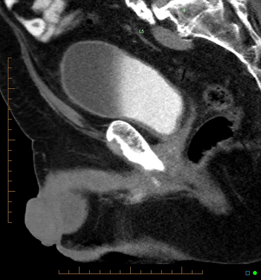 File:Artificial urethral sphincter (Radiopaedia 46937-51464 Sagittal C+ delayed 22).jpg