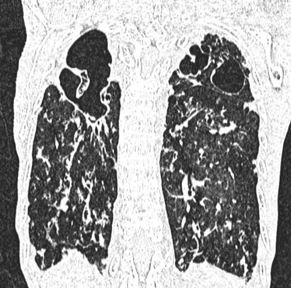 Aspergilloma- with Monod sign (Radiopaedia 44737-48532 Coronal lung window 345).jpg