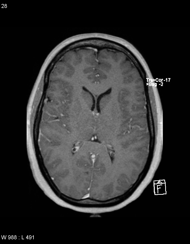 Astroblastoma (Radiopaedia 39792-42217 Axial T1 C+ 27).jpg