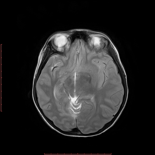 File:Astroblastoma (Radiopaedia 74287-85162 Axial T2 9).jpg