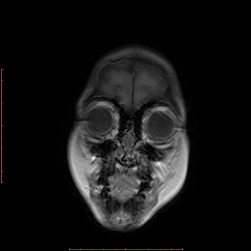 File:Astroblastoma (Radiopaedia 74287-85162 Coronal T1 1).jpg
