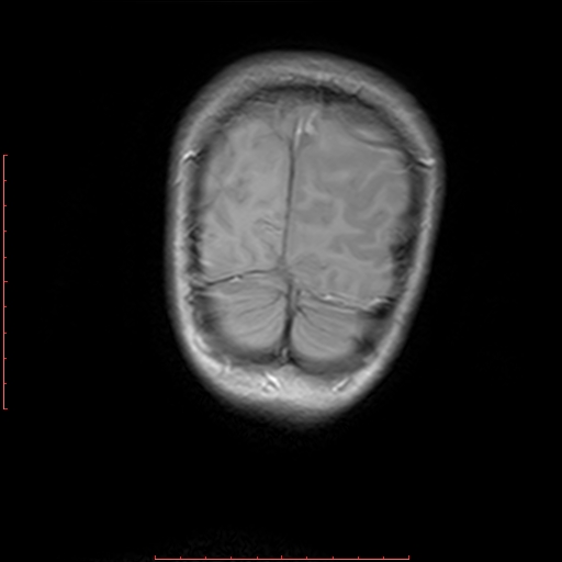 File:Astroblastoma (Radiopaedia 74287-85162 Coronal T1 22).jpg