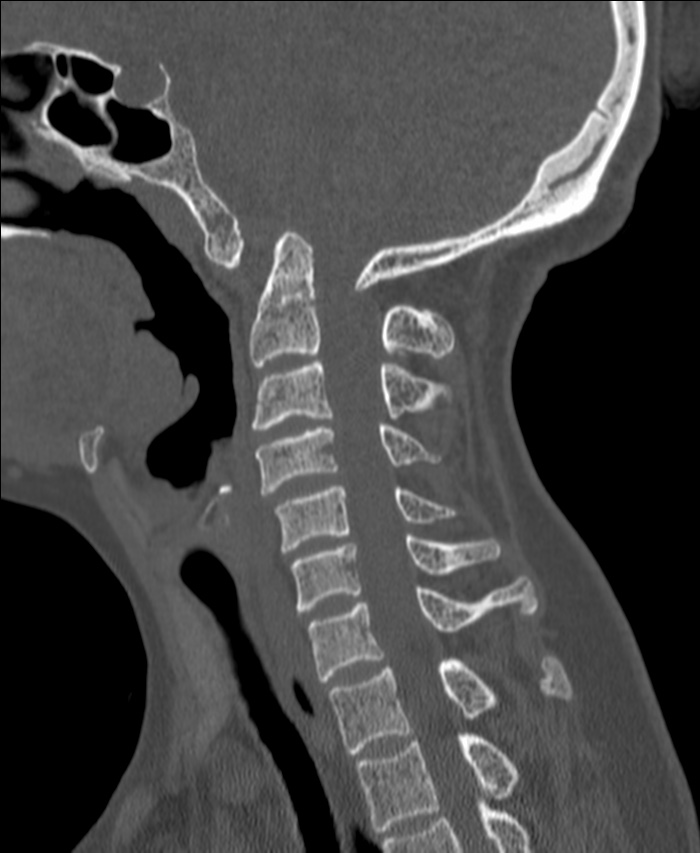 Atlanto-occipital assimilation with basilar invagination (Radiopaedia 70122-80188 Sagittal bone window 57).jpg