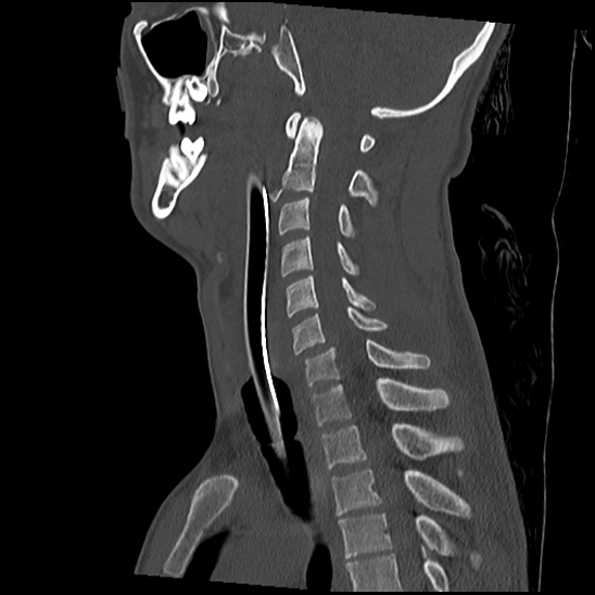 Atlanto-occipital dissociation (Traynelis type 1), C2 teardrop fracture, C6-7 facet joint dislocation (Radiopaedia 87655-104061 Sagittal bone window 36).jpg