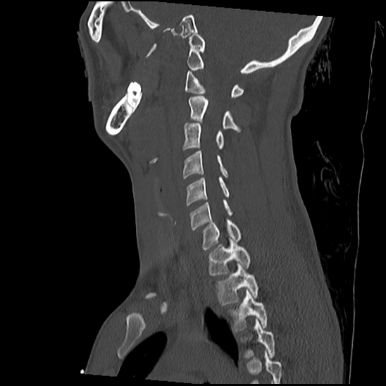 File:Atlanto-occipital dissociation (Traynelis type 1), C2 teardrop fracture, C6-7 facet joint dislocation (Radiopaedia 87655-104061 Sagittal bone window 42).jpg