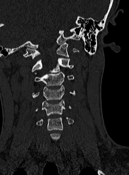 Atlantoaxial subluxation (Radiopaedia 44681-48450 Coronal bone window 49).jpg