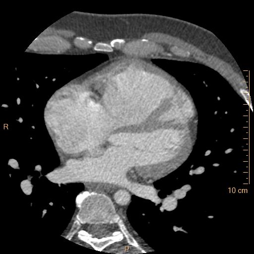 Atrial septal defect (upper sinus venosus type) with partial anomalous pulmonary venous return into superior vena cava (Radiopaedia 73228-83961 A 142).jpg