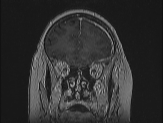 File:Atypical meningioma (Radiopaedia 62985-71406 Coronal T1 C+ 25).jpg