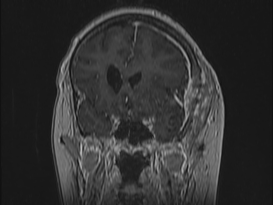 Atypical meningioma (Radiopaedia 62985-71406 Coronal T1 C+ 37).jpg