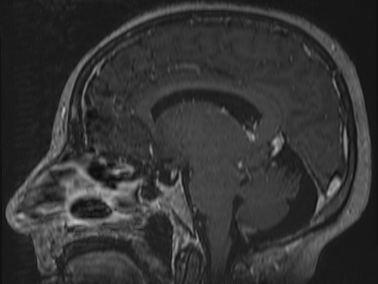 Atypical meningioma (Radiopaedia 62985-71406 Sagittal T1 C+ 45).jpg