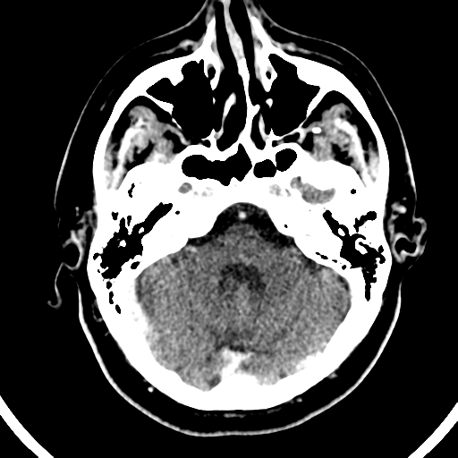 Atypical meningioma (WHO grade II) with brain invasion (Radiopaedia 57767-64728 Axial C+ 43).png