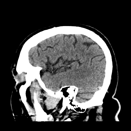 Atypical meningioma (WHO grade II) with brain invasion (Radiopaedia 57767-64728 Sagittal C+ 41).png