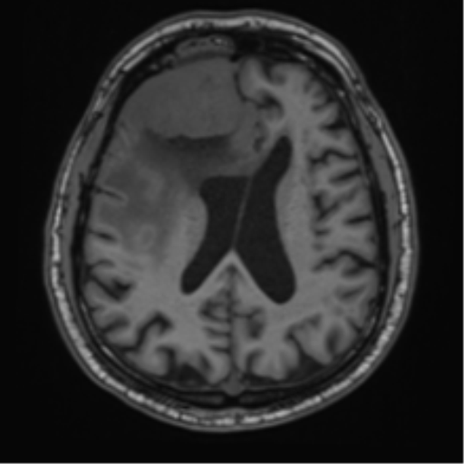 File:Atypical meningioma (WHO grade II) with brain invasion (Radiopaedia 57767-64729 Axial T1 31).png