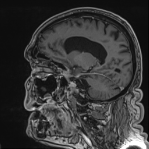 File:Atypical meningioma (WHO grade II) with brain invasion (Radiopaedia 57767-64729 Sagittal T1 C+ 30).png