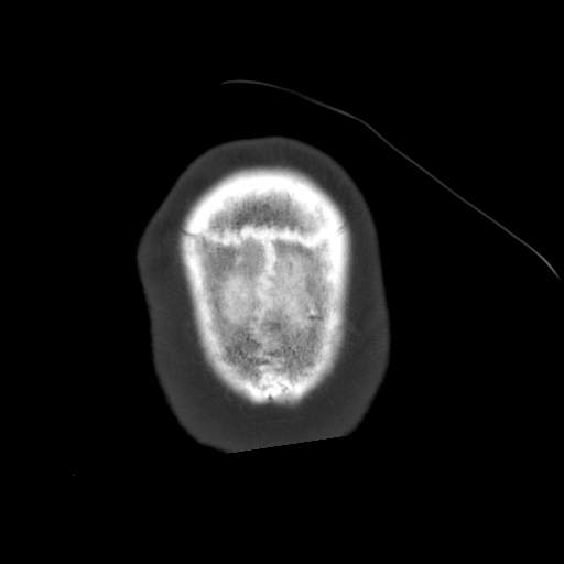 Atypical meningioma with skull invasion (Radiopaedia 34357-35649 Axial bone window 76).png
