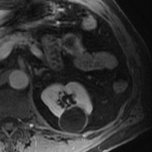 File:Atypical renal cyst on MRI (Radiopaedia 17349-17046 D 11).jpg