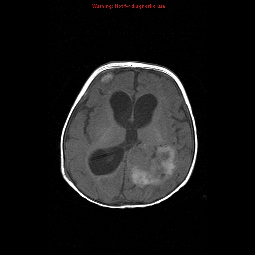 File:Atypical teratoid rhabdoid tumor (Radiopaedia 10712-11183 Axial T1 8).jpg