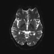 Autoimmune limbic encephalitis (Radiopaedia 30363-31005 Axial B0 and DWI 16).jpg