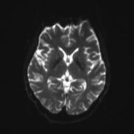 Autoimmune limbic encephalitis (Radiopaedia 30363-31005 Axial B0 and DWI 17).jpg