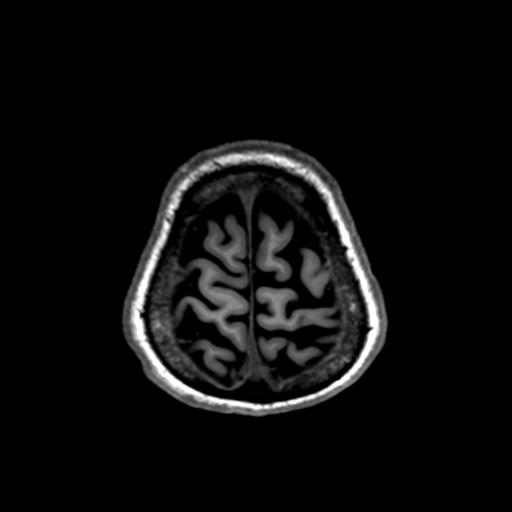 Autoimmune limbic encephalitis (Radiopaedia 30363-31005 T1 Axial 1mm 136).jpg
