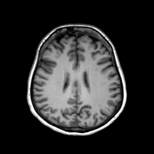 Autoimmune limbic encephalitis (Radiopaedia 30363-31005 T1 Axial 3mm 33).jpg