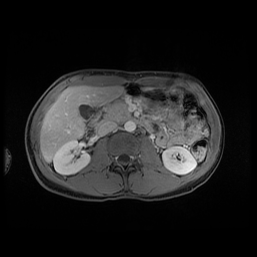 Autoimmune pancreatitis (Radiopaedia 69751-79729 M 76).jpg