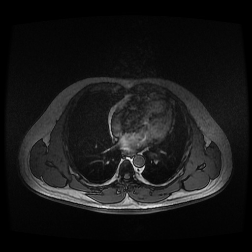 Autosomal dominant polycystic kidney disease (Radiopaedia 50259-55611 Axial 2D Dual Echo 1).jpg