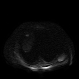 Autosomal dominant polycystic kidney disease (Radiopaedia 50259-55611 Axial DWI 74).jpg