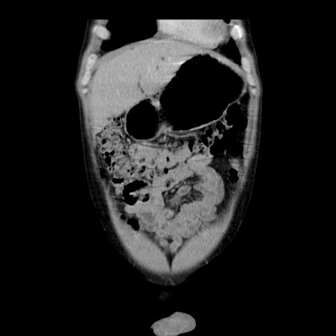 Autosomal dominant polycystic kidney disease (Radiopaedia 66349-75582 A 4).jpg