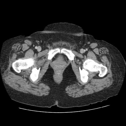 File:Autosomal dominant polycystic kidney disease with hepatic involvement (Radiopaedia 32693-33662 B 82).jpg