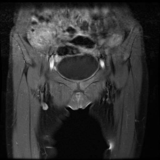 File:Avascular necrosis of the hip (Radiopaedia 29563-30067 I 1).jpg