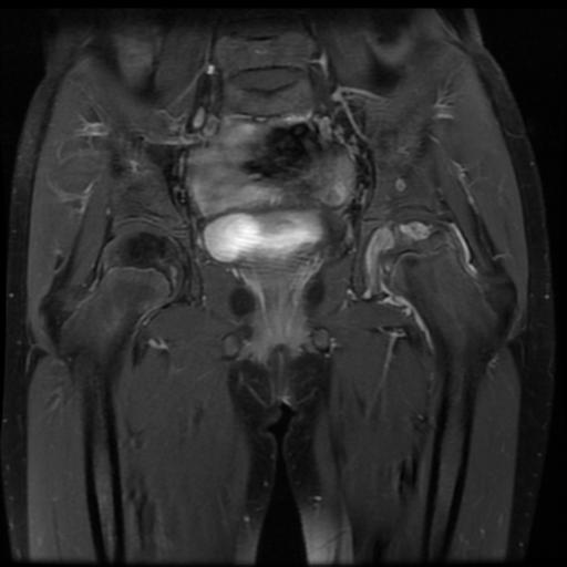 File:Avascular necrosis of the hip (Radiopaedia 29563-30067 I 8).jpg