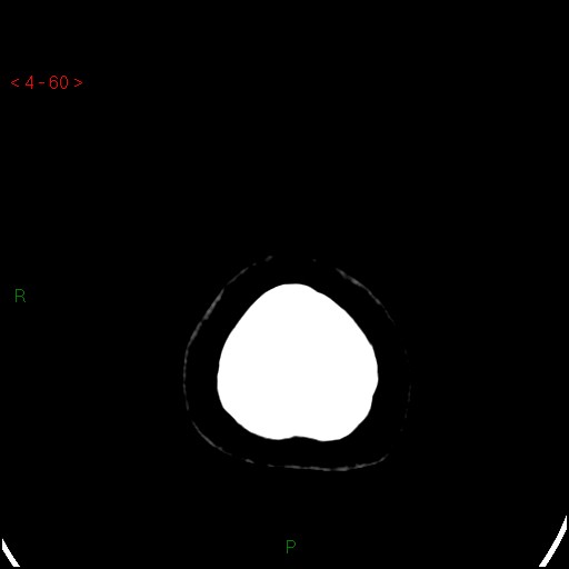 Azygos anterior cerebral artery (Radiopaedia 51987-57833 A 60).jpg