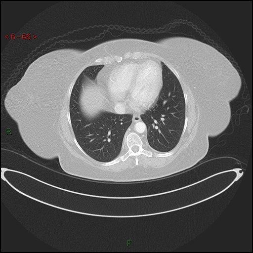 File:Azygos fissure and lobe (Radiopaedia 47620-52278 Axial lung window 66).jpg