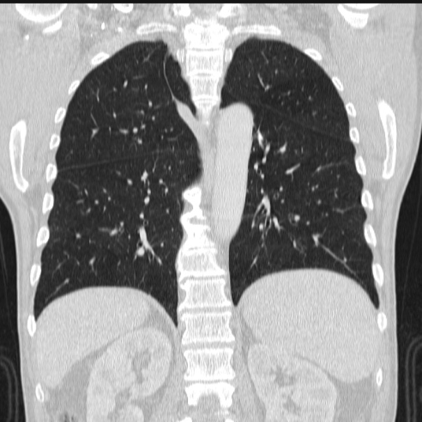 Azygos lobe (Radiopaedia 38259-40275 Coronal lung window 55).jpg