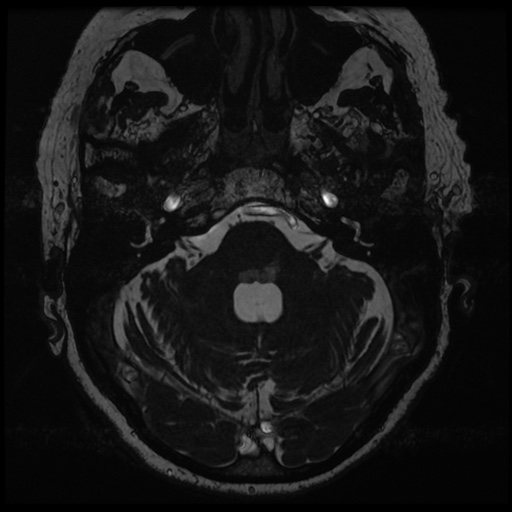 File:Balo concentric sclerosis (Radiopaedia 53875-59982 Axial T2 FIESTA 31).jpg