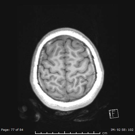 File:Balo concentric sclerosis (Radiopaedia 61637-69636 Axial T1 77).jpg