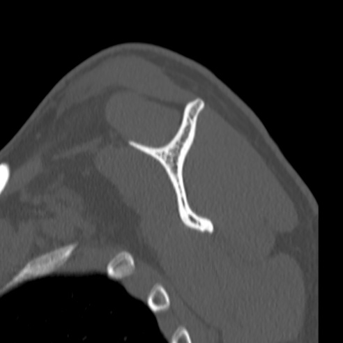 Bankart lesion (Radiopaedia 57256-64185 Sagittal bone window 41).jpg