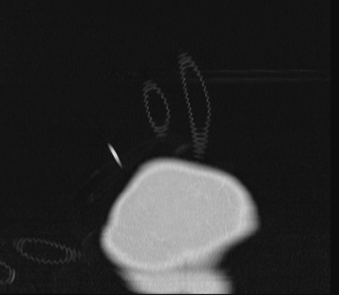 Barotrauma due to mechanical ventilation (Radiopaedia 28079-28336 Coronal lung window 1).jpg