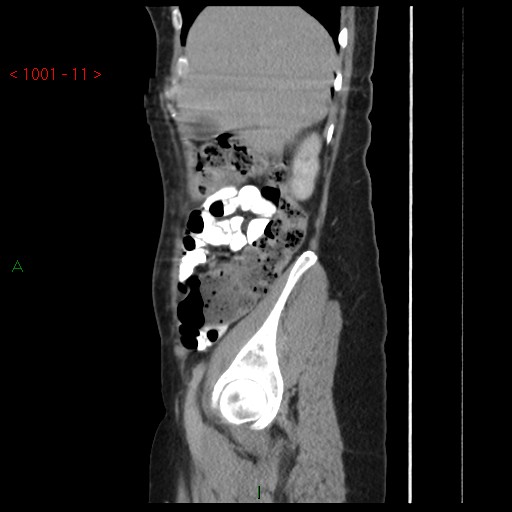 File:Bartholin gland cyst (Radiopaedia 54904-61181 Sagittal C+ delayed 11).jpg
