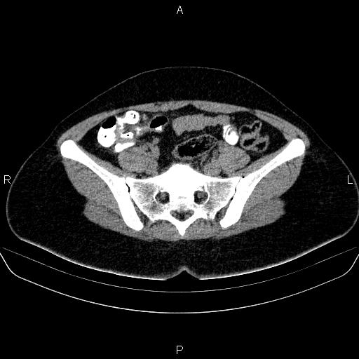 Bartholin gland cyst (Radiopaedia 62635-70930 Axial non-contrast 23).jpg