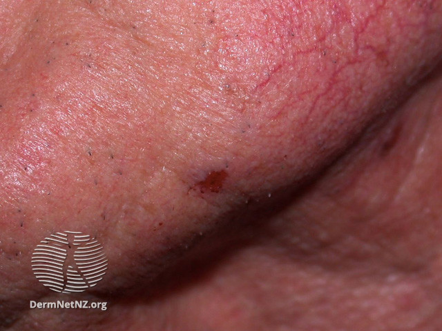 Basal cell carcinoma affecting the face (DermNet NZ lesions-bcc-face-0994).jpg