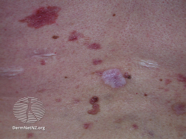 File:Basal cell carcinoma affecting the trunk (DermNet NZ lesions-bcc-trunk-1103).jpg